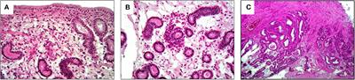 Case Report: Use of Amniotic Microvesicles for Regenerative Medicine Treatment of a Mare With Chronic Endometritis